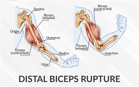 distal biceps tear treatment